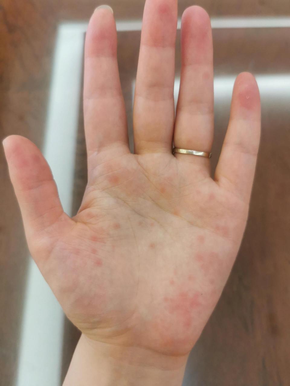 手心为啥起了红点点,还不痒 手掌突然就有了这个红点,按下去也是红的