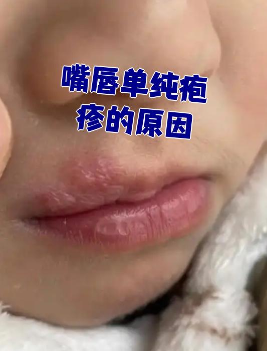 嘴唇单纯疱疹通常有两种常见原因:吃太多辛辣