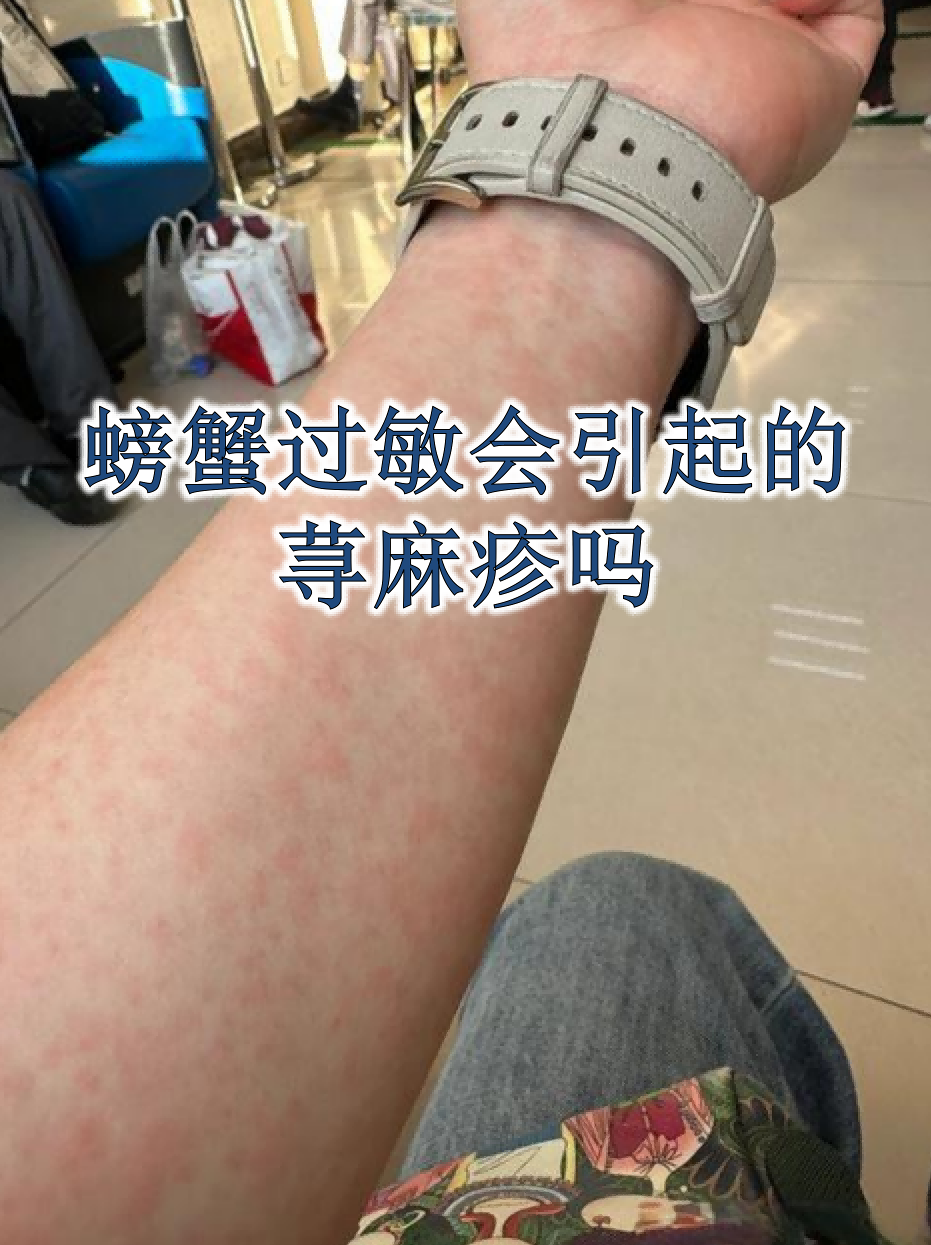 螃蟹过敏会引起的荨麻疹吗