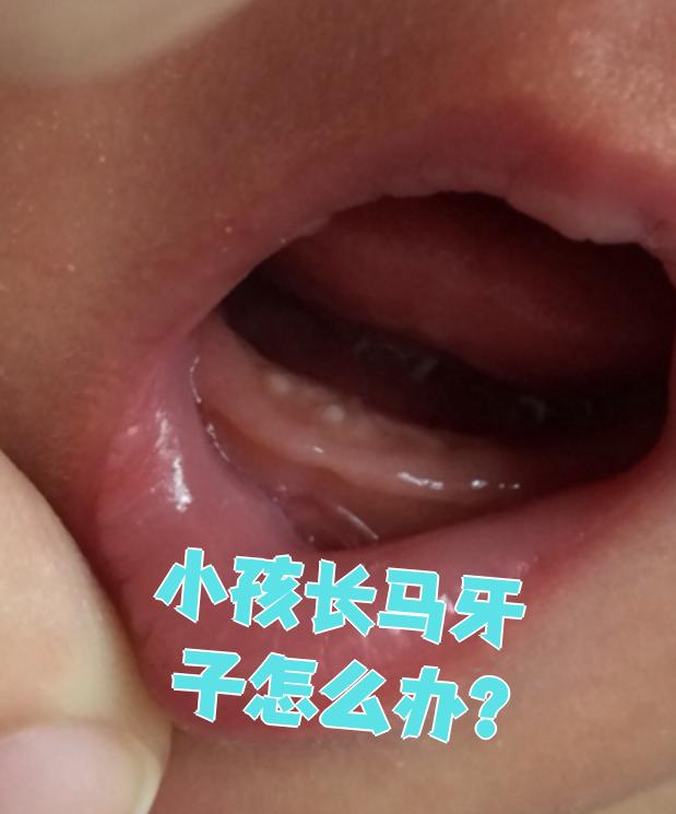 马牙子通常出现在新生儿或1
