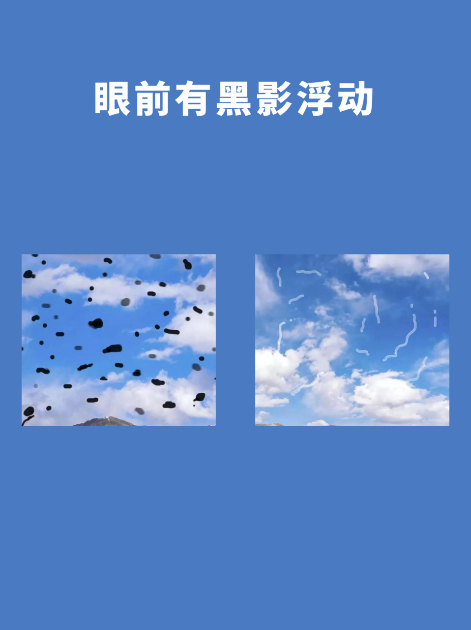 你会不会有时会感觉眼前有黑影浮动?