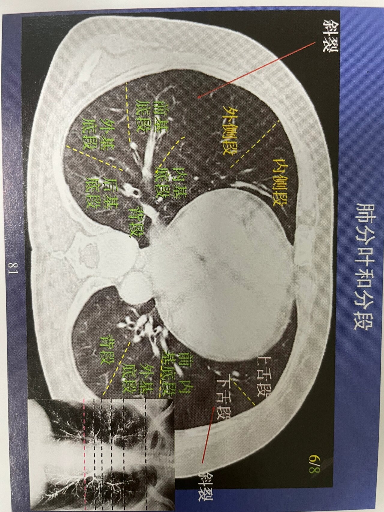 肺ct分叶分段解剖图图片