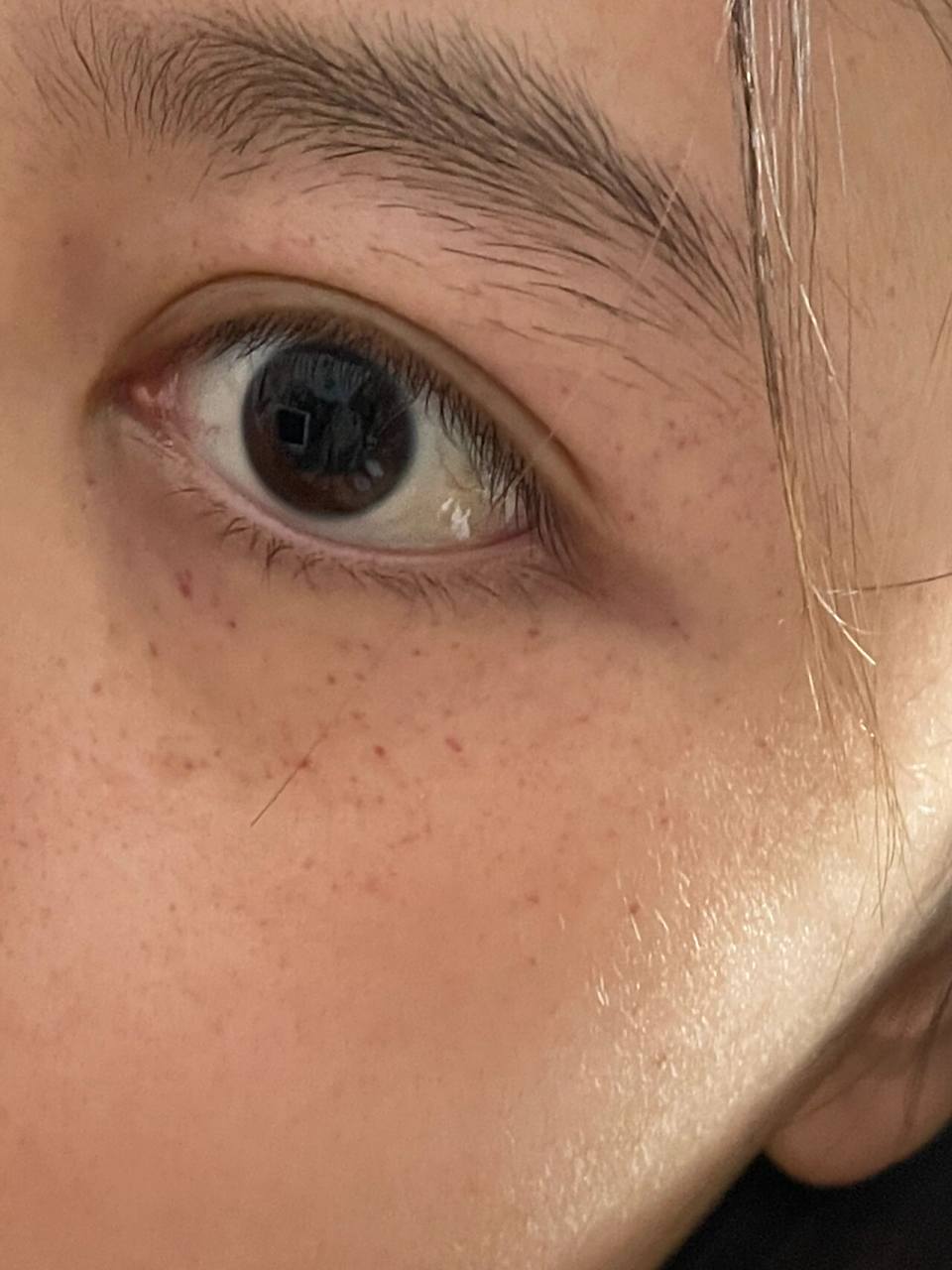 原来呕吐以后眼周的红斑是因为这样 今天洗澡时感觉因为一些事感觉很