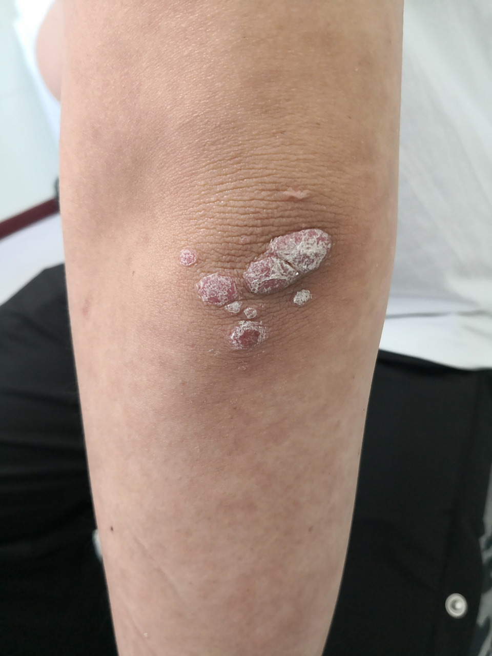 肘部银屑病斑块症状.