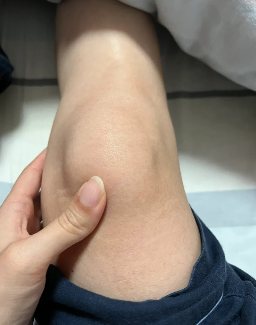 弯腿时膝盖吱吱响还经常疼,最常见的原因是膝关节半月板损伤,骨关节