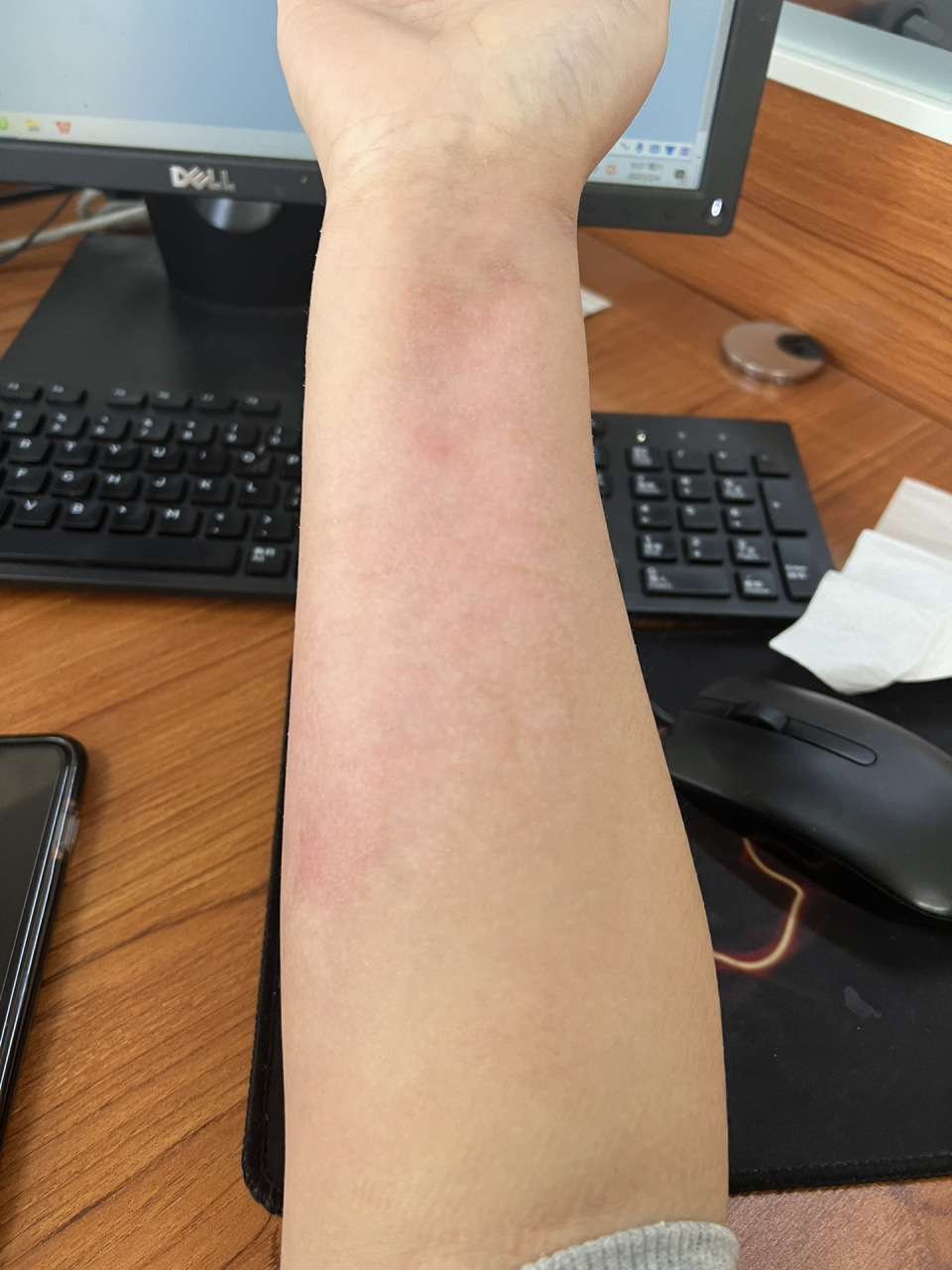 烫伤恢复20天   周边的皮已经掉没了,已经融合的差不多了,新皮肤有点