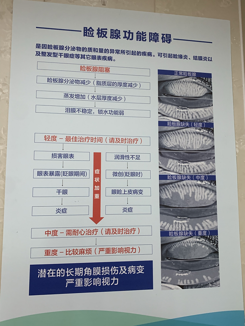 睑板腺缺失 干眼症 bkc 我的治疗经历 本人情况9799左眼850带散光