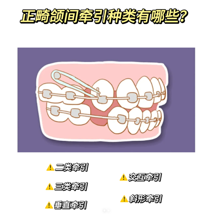 牙齿二类牵引示意图图片