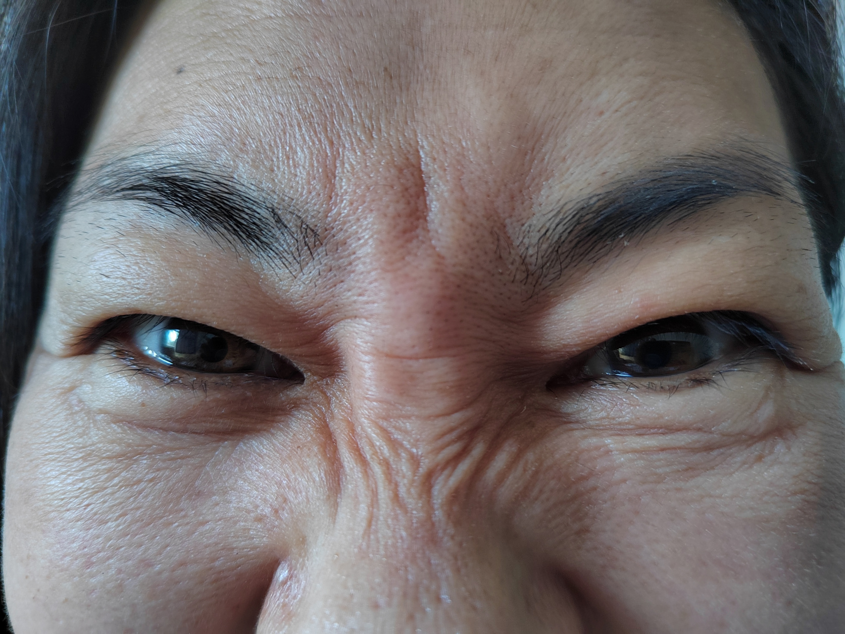 面部眉间纹抬头纹眼角纹鼻背纹颈纹都是可以治疗的.