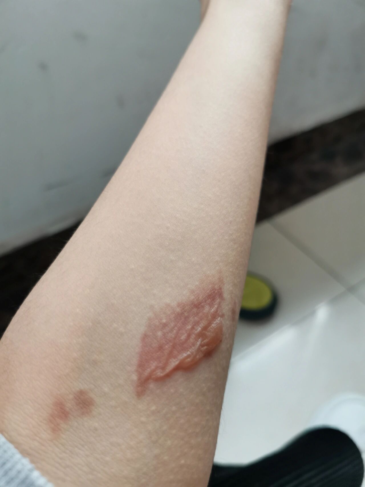 烫伤起泡 弟4天了