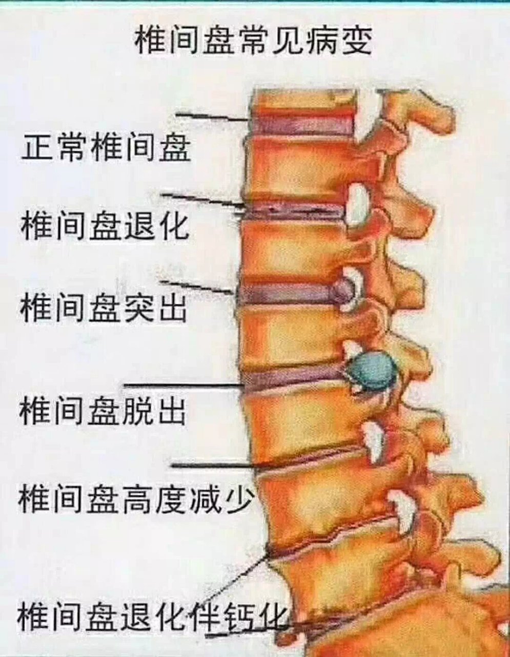 什么是腰间盘膨出,突出,脱出?