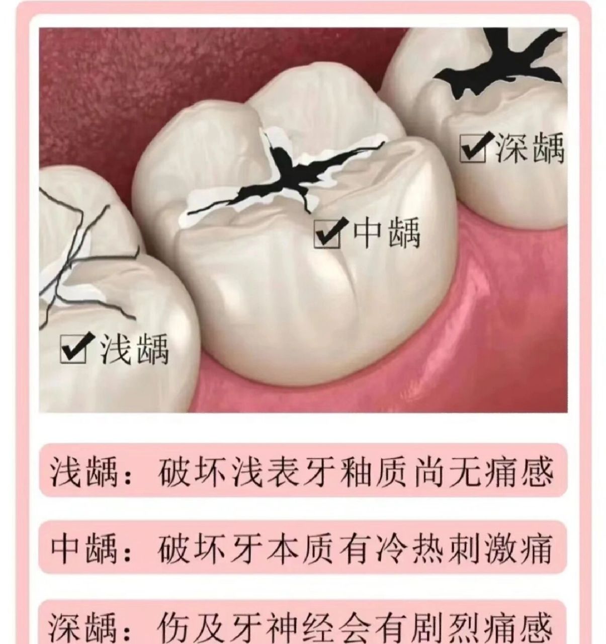 你知道补牙为什么要钻个洞吗71 当龋齿发生时,局部组织变软变色
