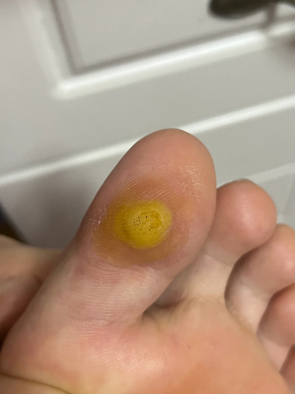 鸡眼 到底怎么样才能好[流泪]走路太痛苦了 液氮冷冻了两次 好痛啊