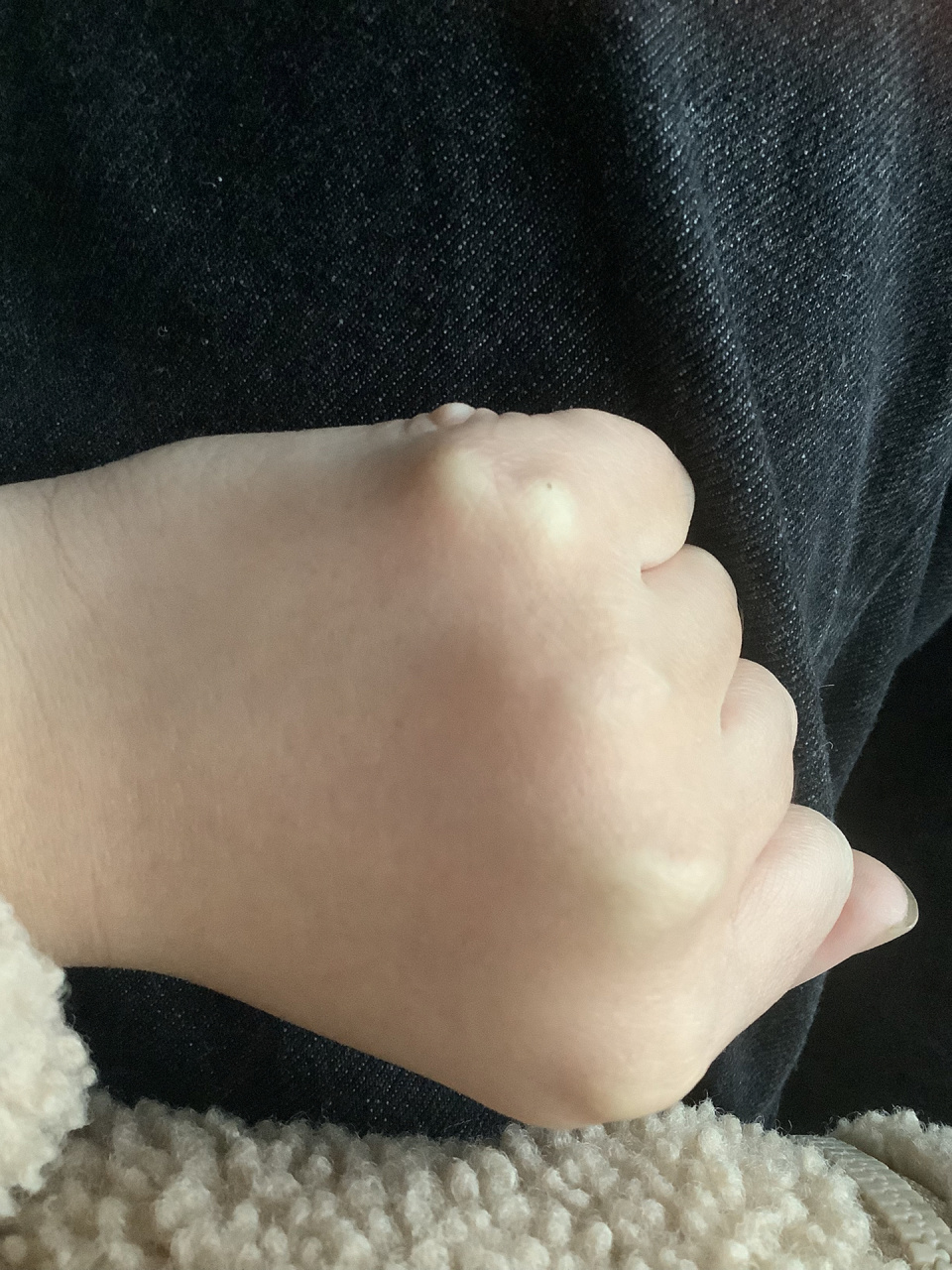 手上多长了一个小骨头是怎么回事啊