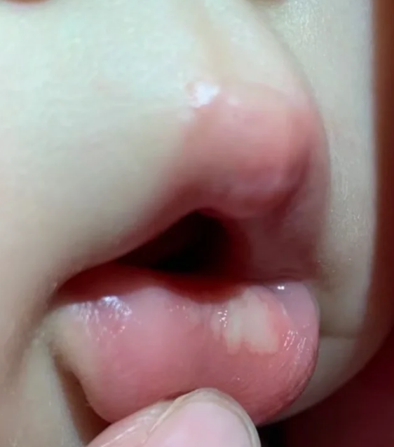 宝宝嘴唇出现白色溃疡样东西,常见原因有三种.第一种是奶水浸泡