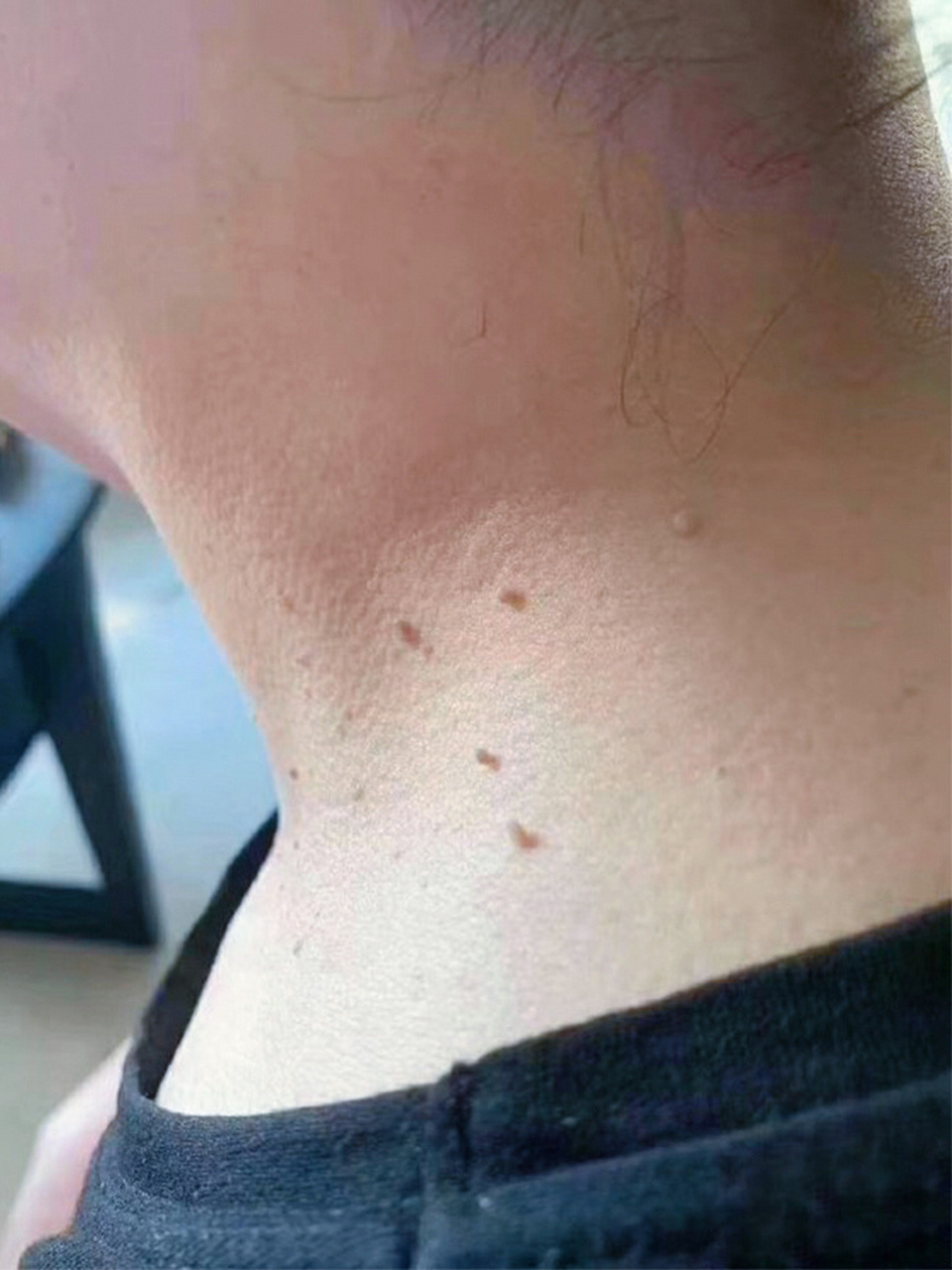 疣第一名05 我是大概16615年前发现自己脖子上有一颗小黑痘痘