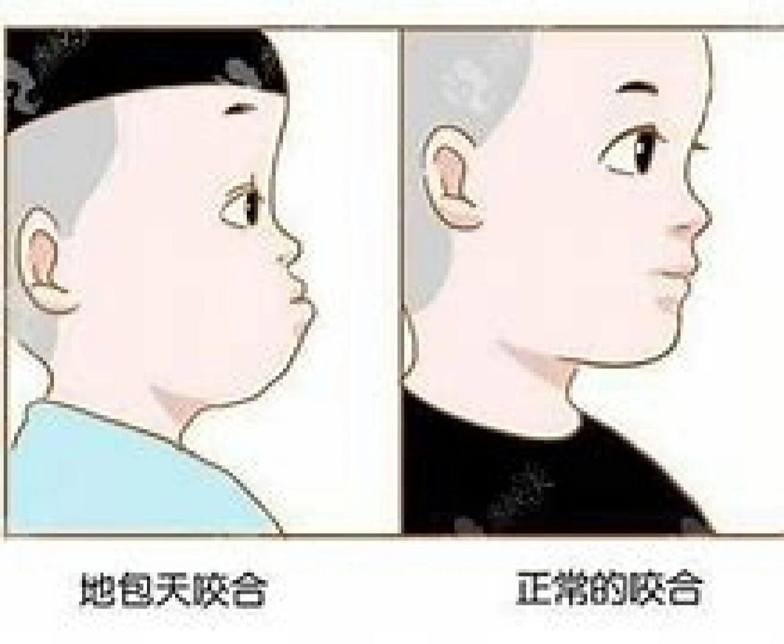 为何会出现地包天以及最佳治疗时间 1,遗传因素引起,如果父母中有人是