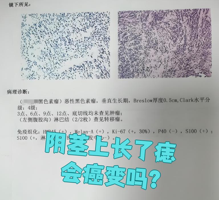 关于为什么阴茎越来越黑的信息 关于为什么阴茎越来越黑的信息