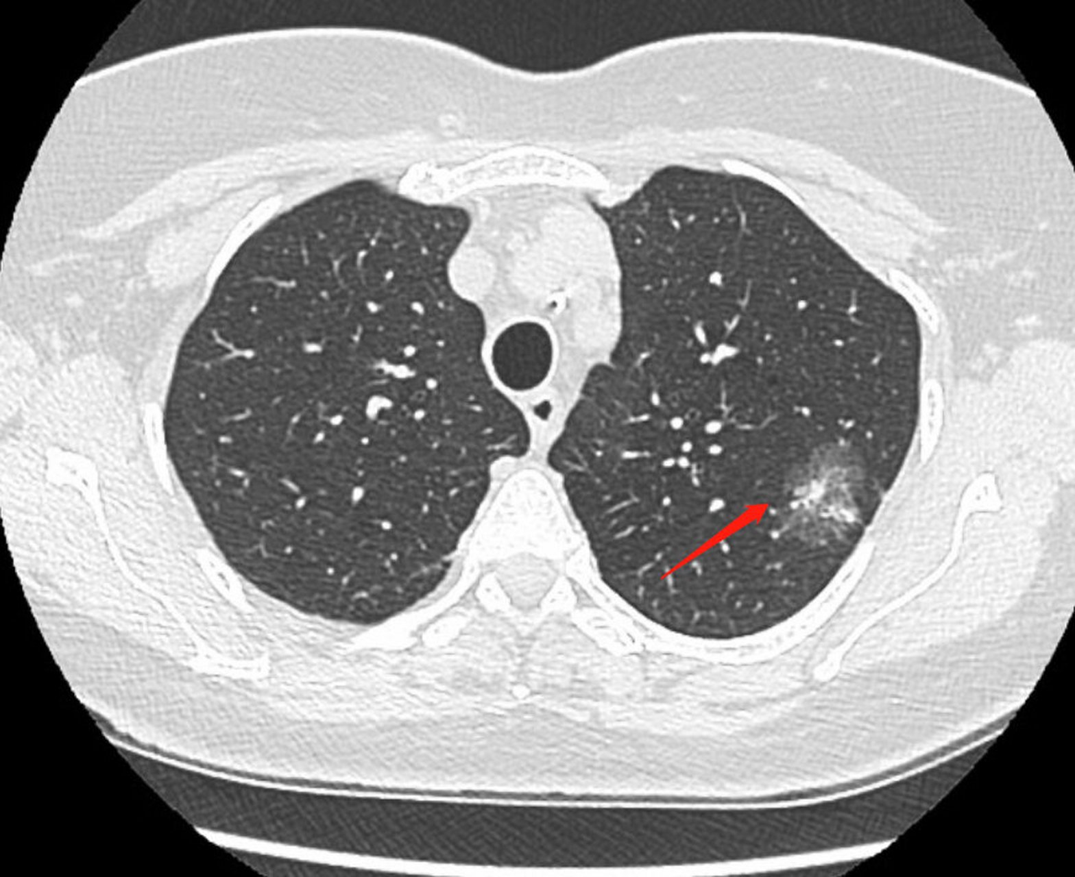 肺癌对应的ct影像