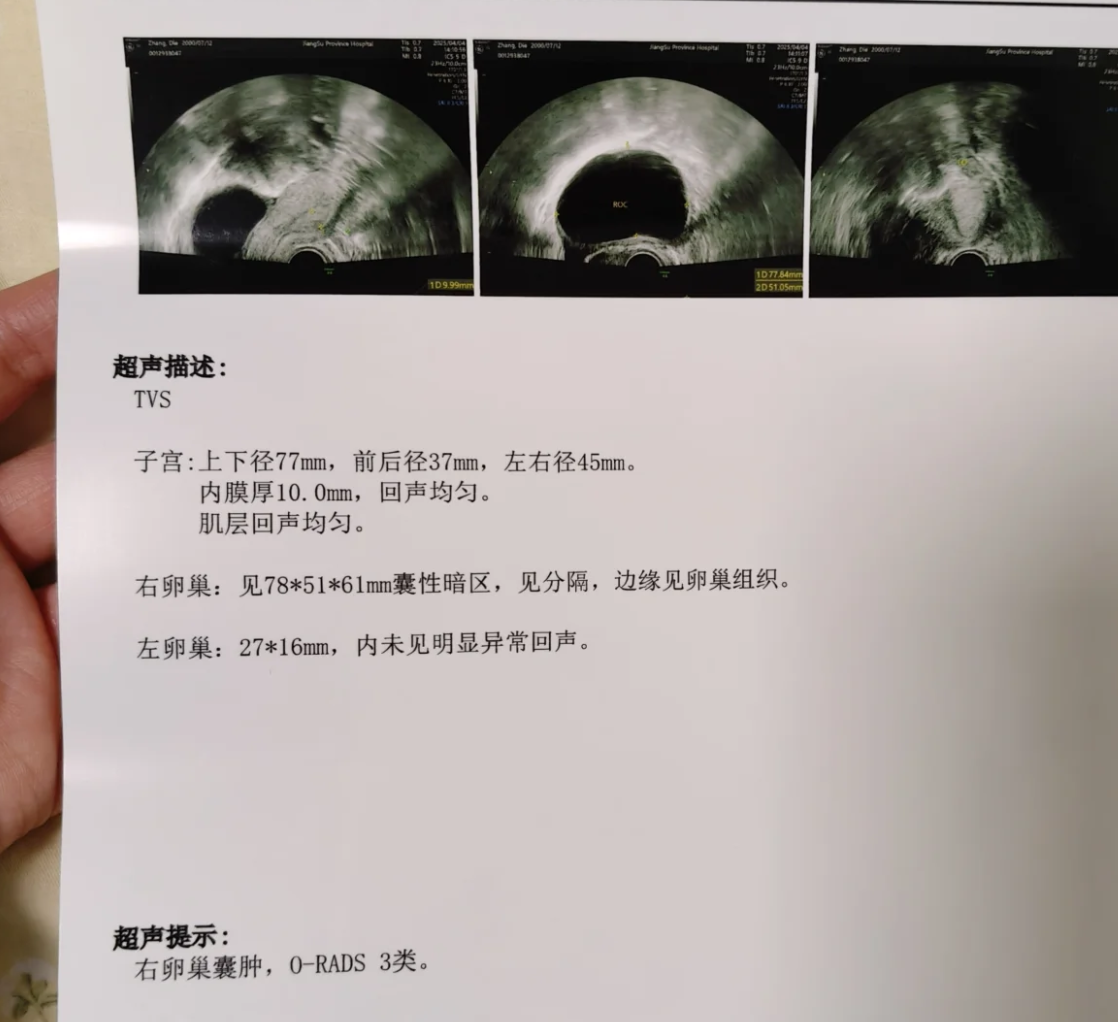 阴超检查发现囊肿后不用太紧张,关键要看囊肿的类型和具体情况