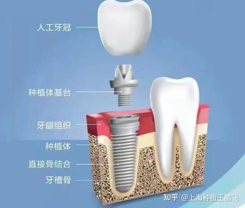 我想问下种植牙哪种材质好