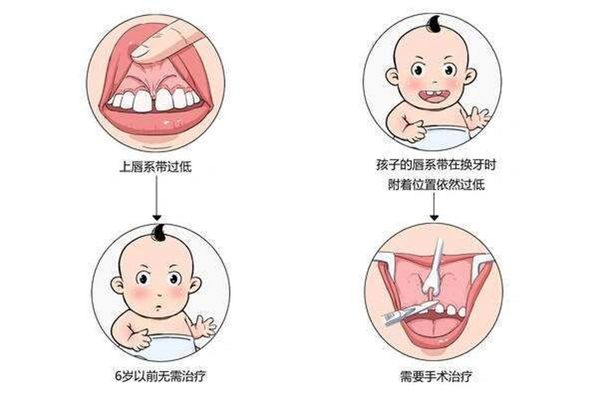 上唇系带 宝宝18个月了 长了10颗牙 出牙晚 上唇系带短 这样正常吗