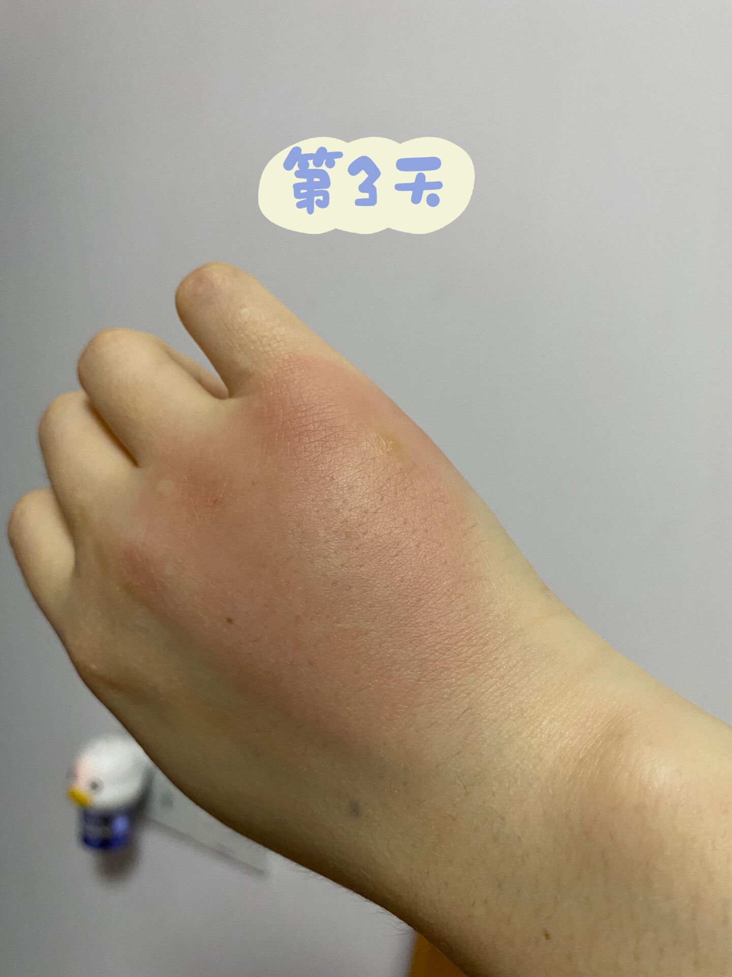 被会飞的蚂蚁🐜🦟咬了一口!太疼了😩