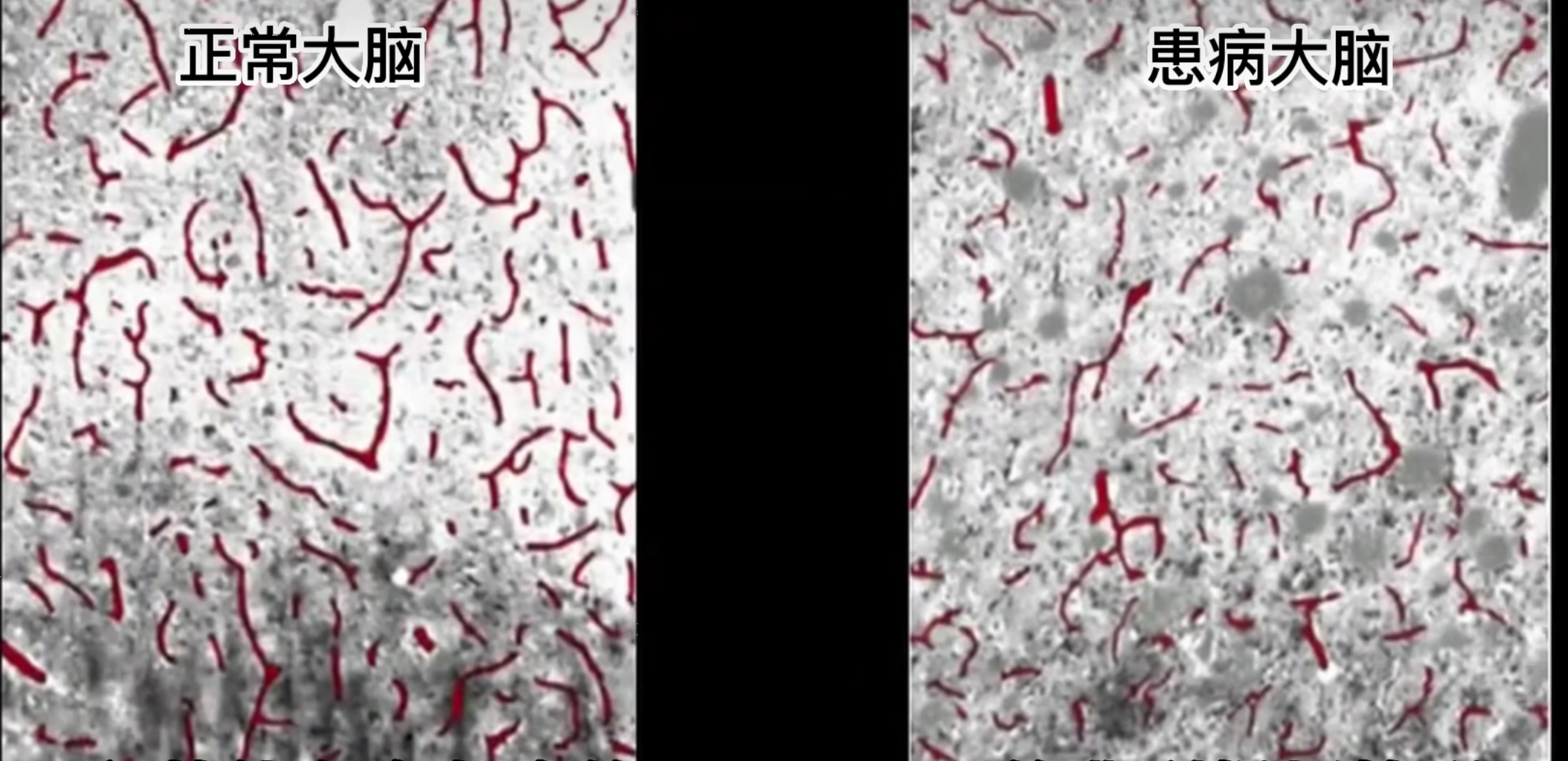 美国现首批僵尸鹿病毒死亡病例#   朊病毒因为非常特殊而具有传圃性