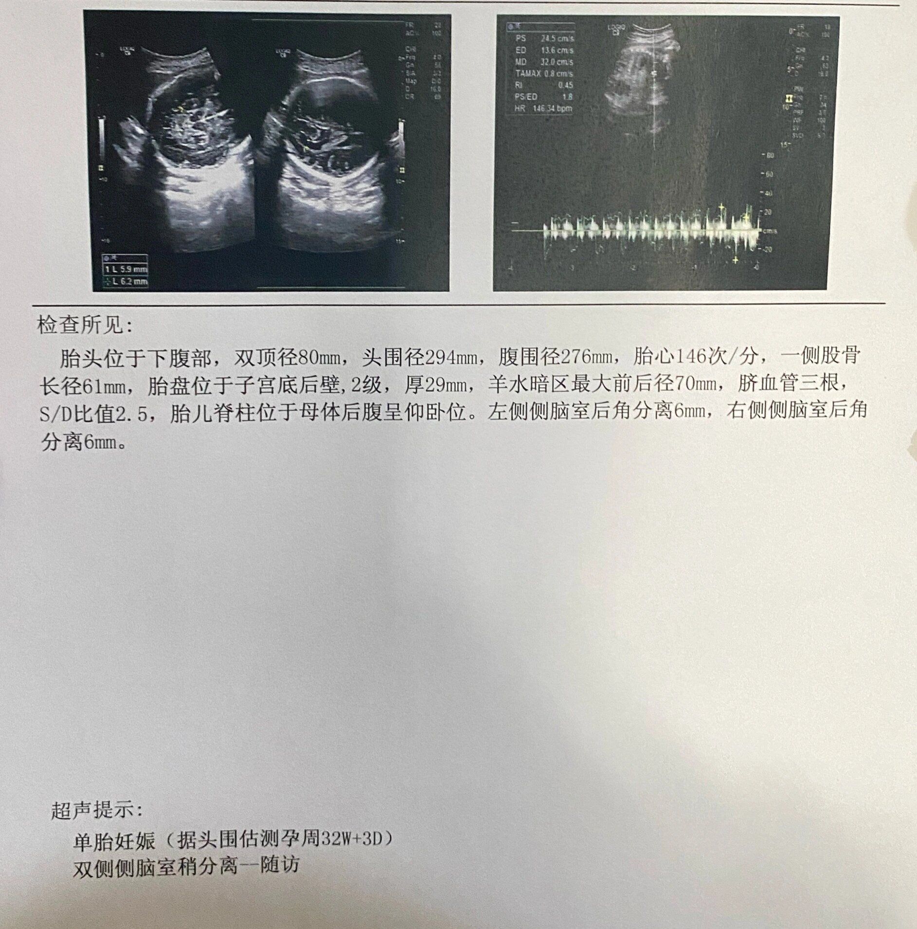 双侧侧脑室后角分离 怀孕真的是操碎了老母亲的玻璃心,每一次的产检就