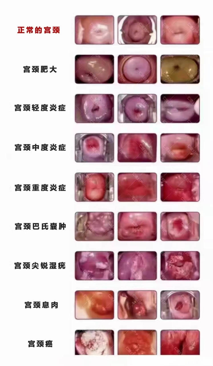 宫颈轻度出血图片图片