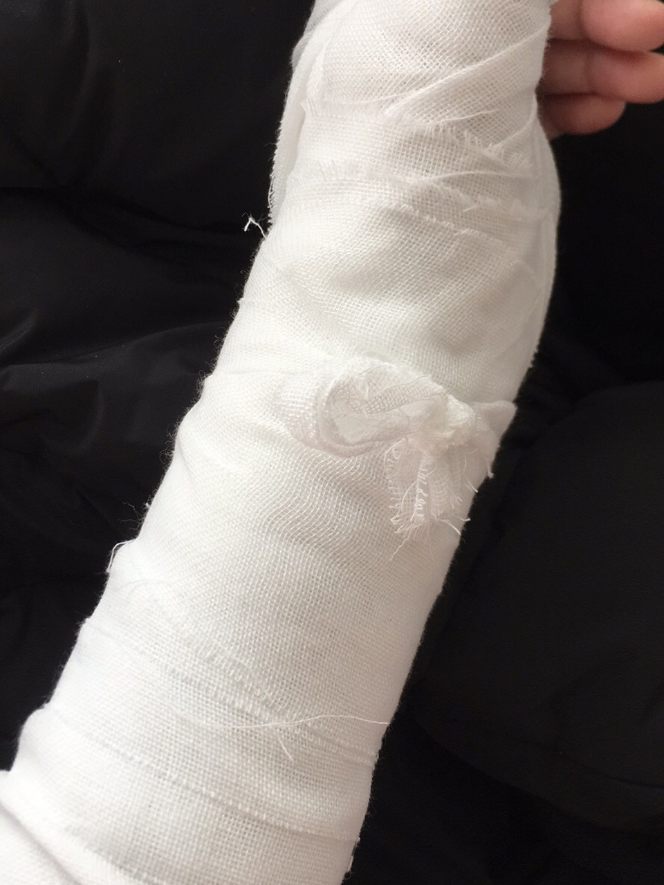 舟状骨骨折已经五个月了,又重新换了新的支架,医生说这次骨头有长出来