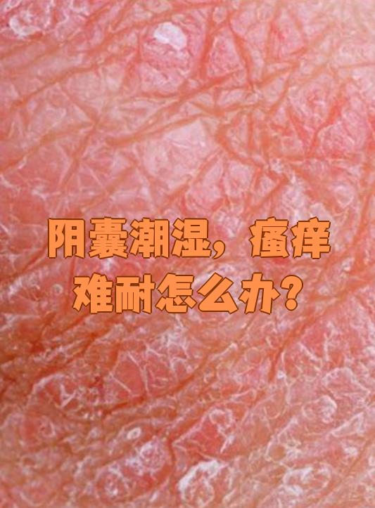 阴囊潮湿瘙痒确实让人难受,这种情况最常见的原因是阴囊湿疹或者