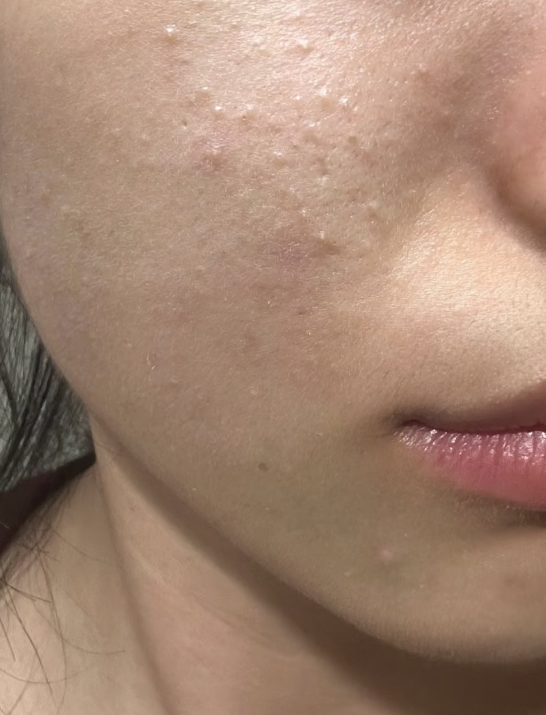 闭口就是封闭性粉刺,通常不会自己消下去