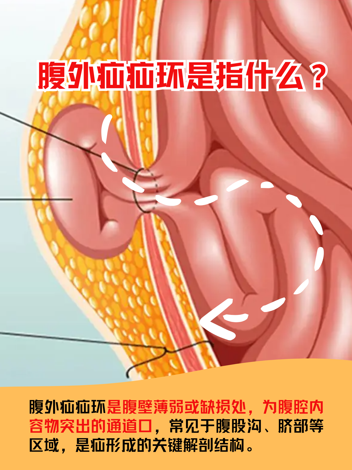 腹外疝疝环是指什么?
