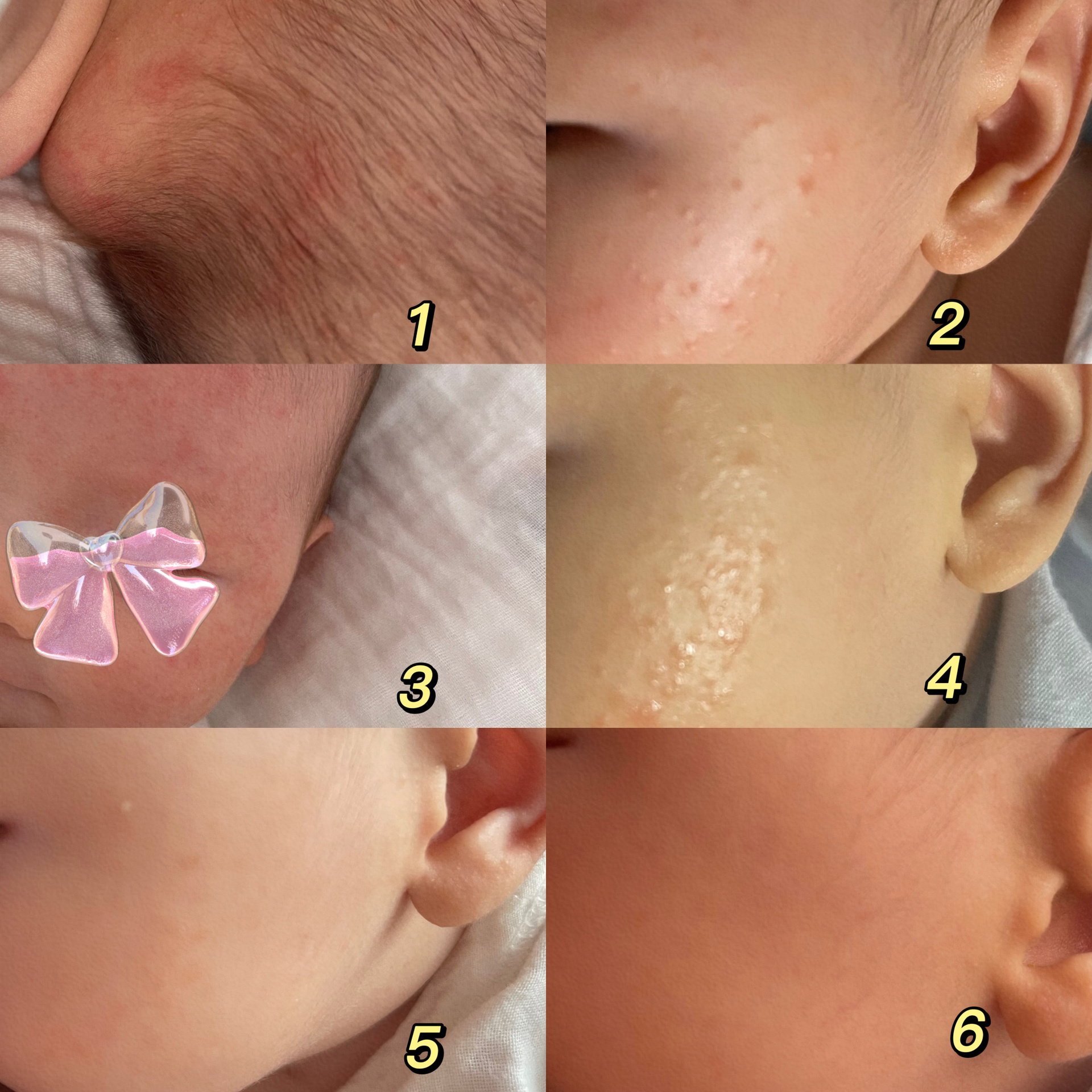 宝宝热疹湿疹怎么办 前段时间去打疫苗给bb包裹的太严实了 回家之后