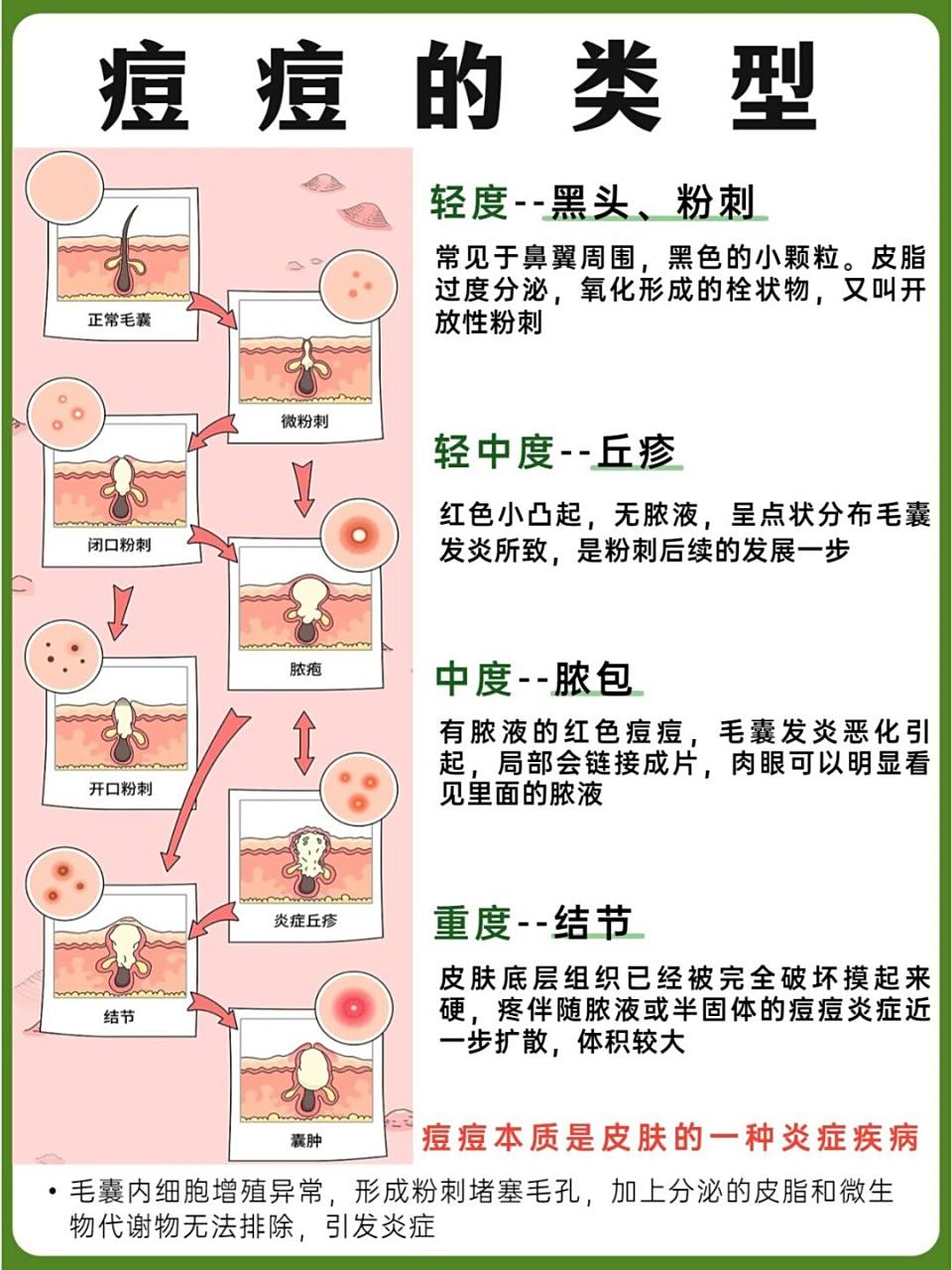 痘痘的几种类型9499如何正确祛痘?