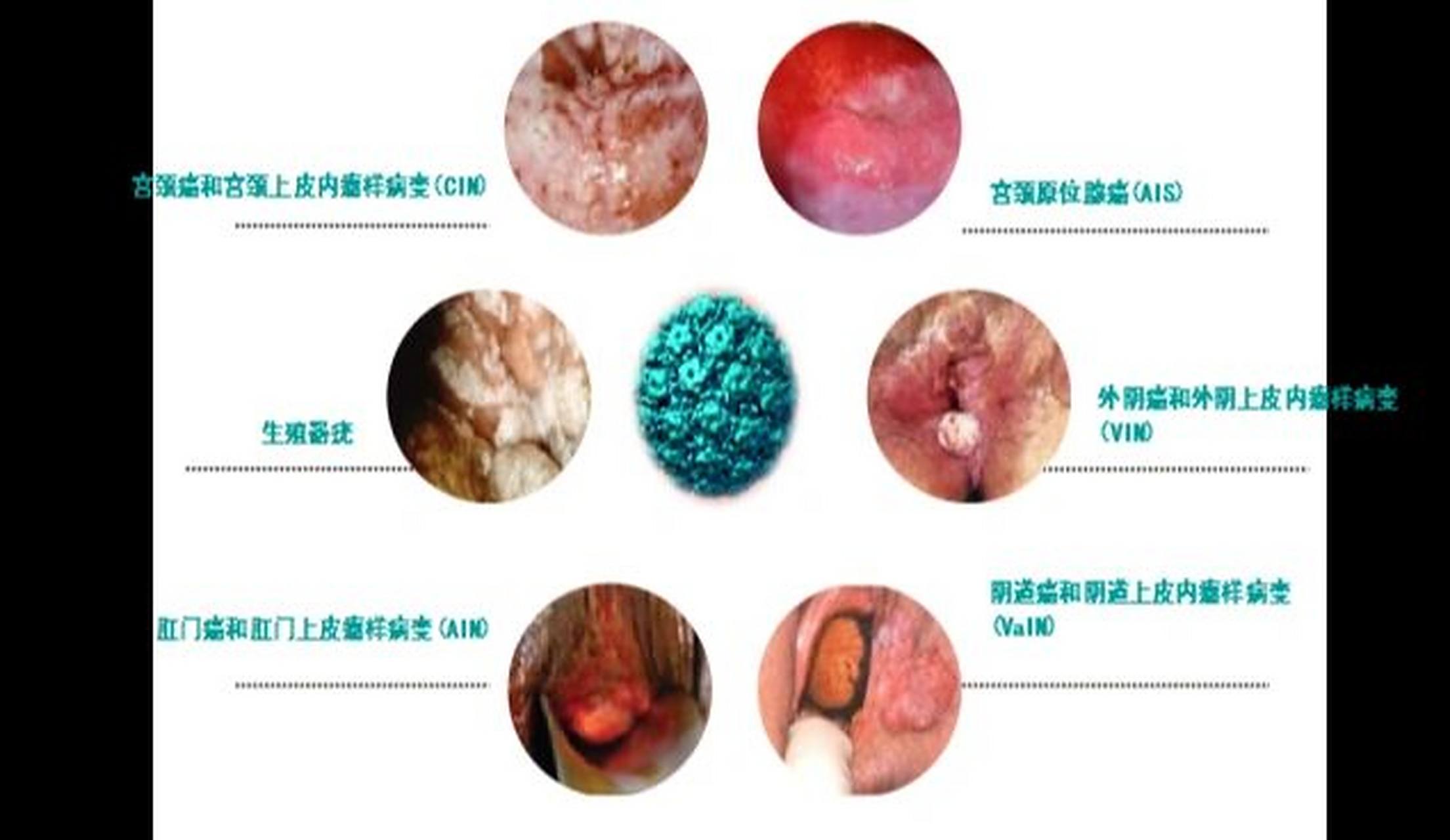 virus,简称hpv)是一种嗜皮性病毒,有高度的特异性,像乙肝病毒一样,hpv