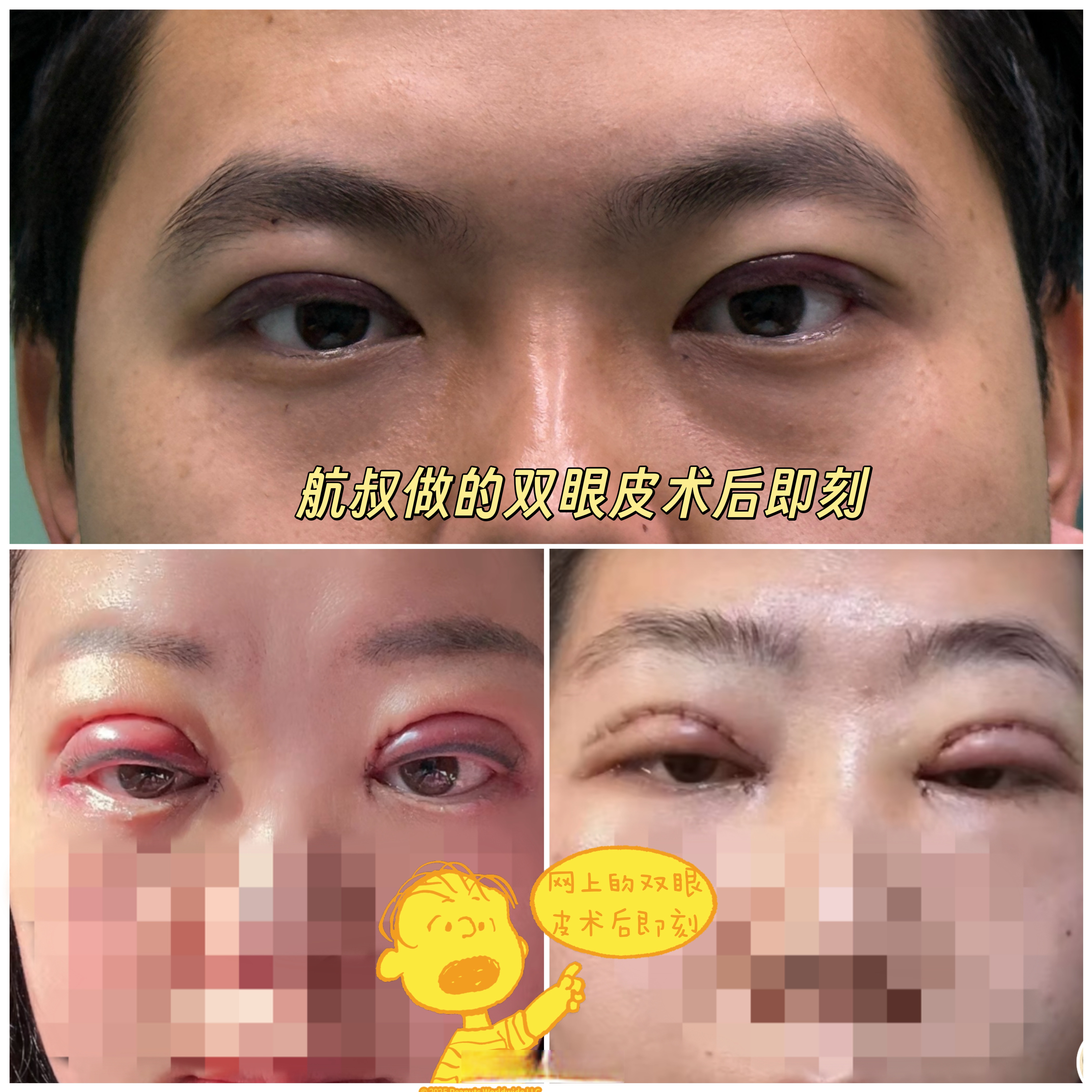 双眼皮的肿胀程度和宽度以及创伤大小都有关,一般术后即刻也能看出