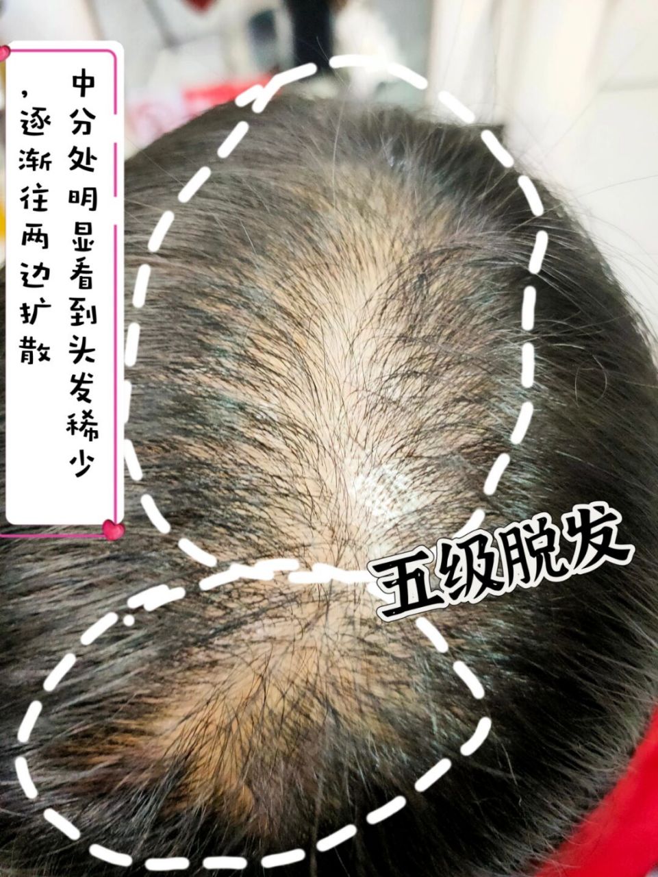 的现象,她没有在意,当时是三级脱发, 82158215现在五级脱发了