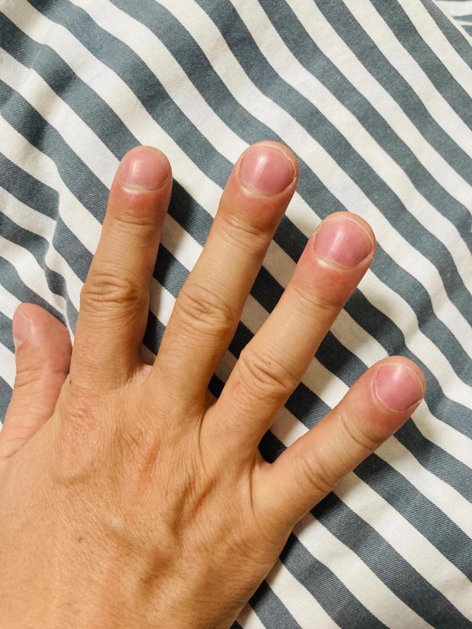 杵状指看过心脏肺胃没找到问题,该怎么办 老公的杵状指,今天又去做了