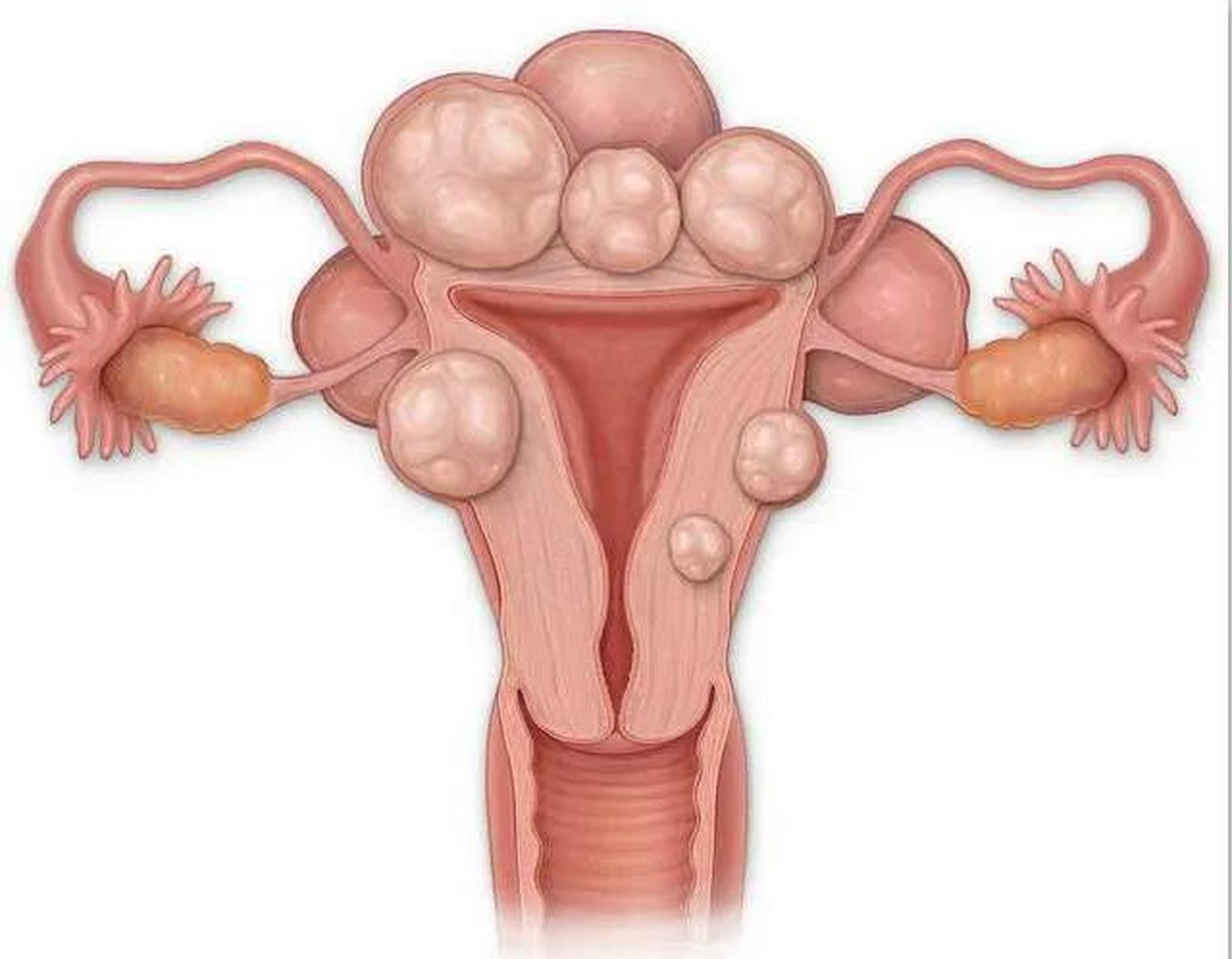 子宫肌瘤是女性常见的一种良性肿瘤,通常生长在子宫壁