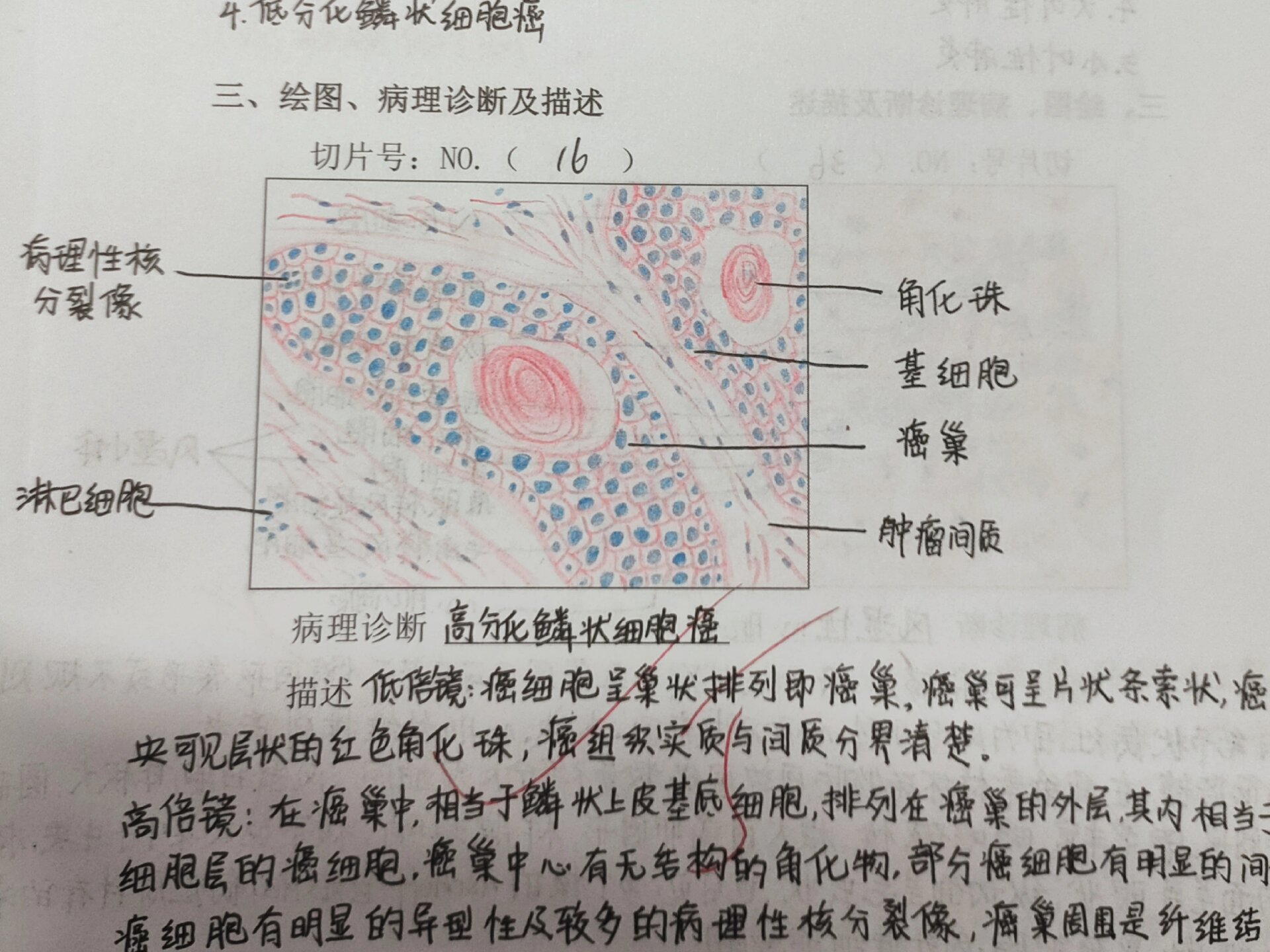 鳞状细胞癌绘图图片