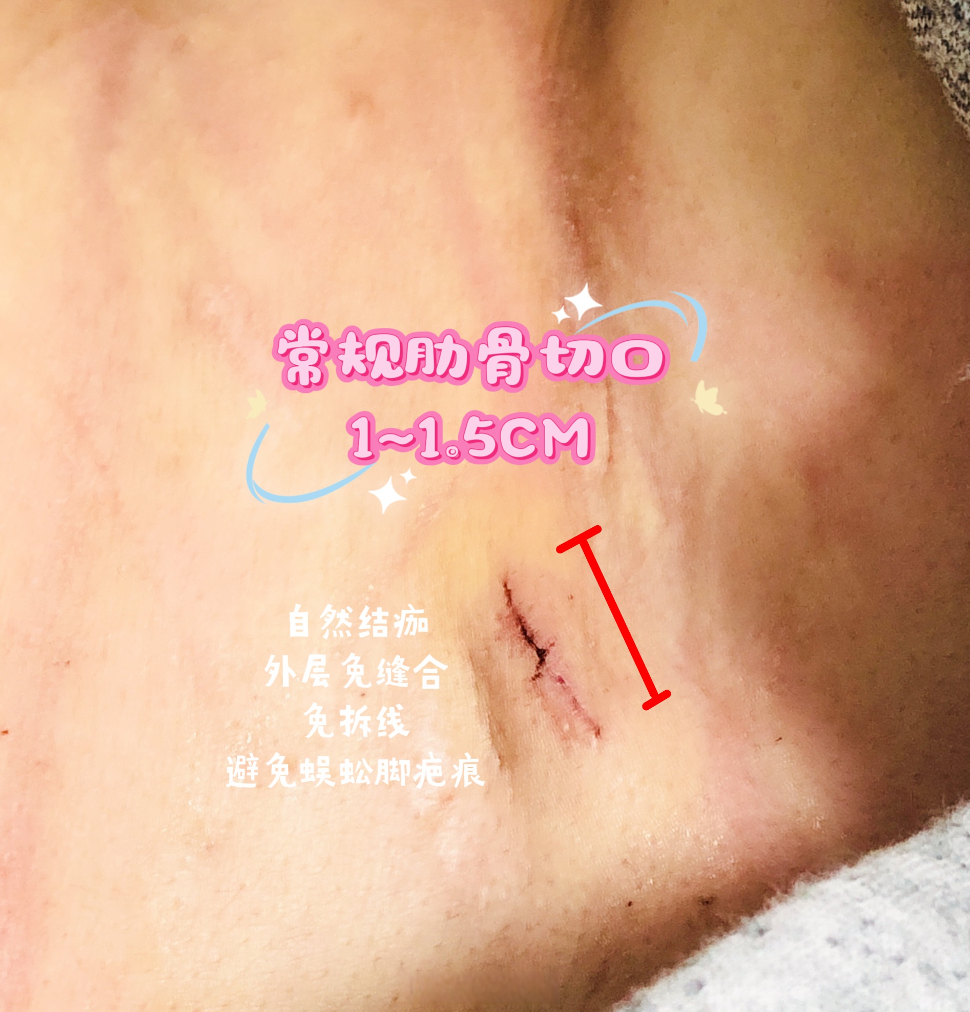 术后切口内部经过特殊处理,痛感较轻