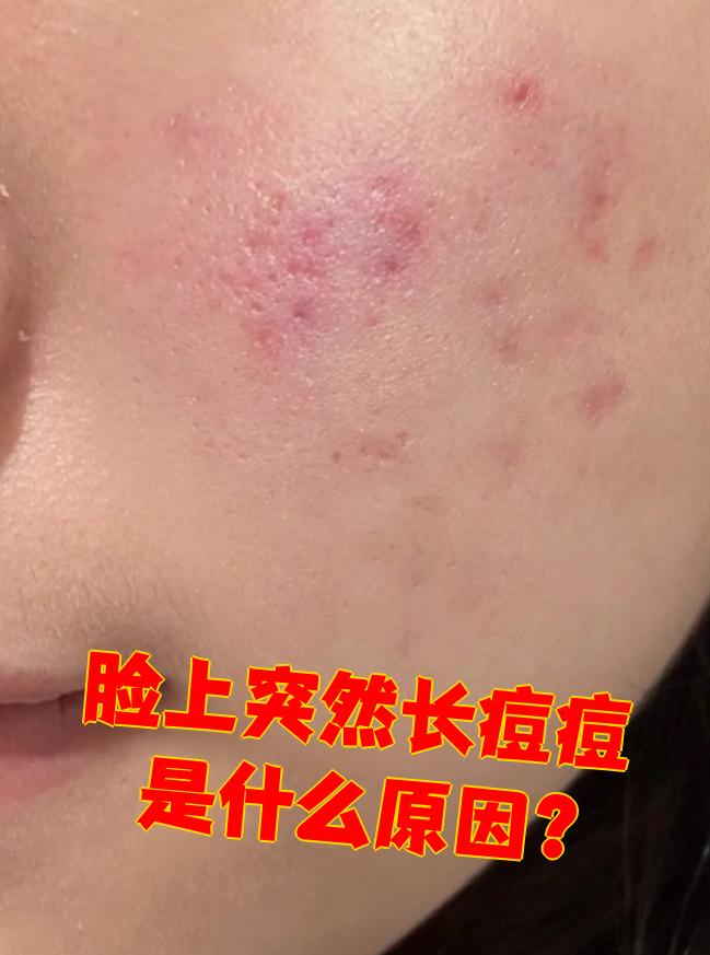 熬夜为什么会长痘痘为什么在线