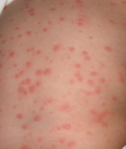 皮肤起红疙瘩很痒,最常见的原因是过敏性皮炎,荨麻疹或丘疹性荨骂疹