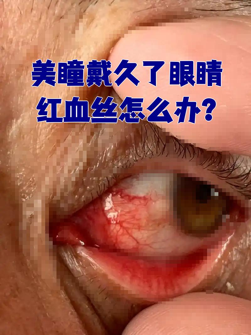长时间戴美瞳后出现红血丝,最常见的原因有两个:一是佩戴时间过长