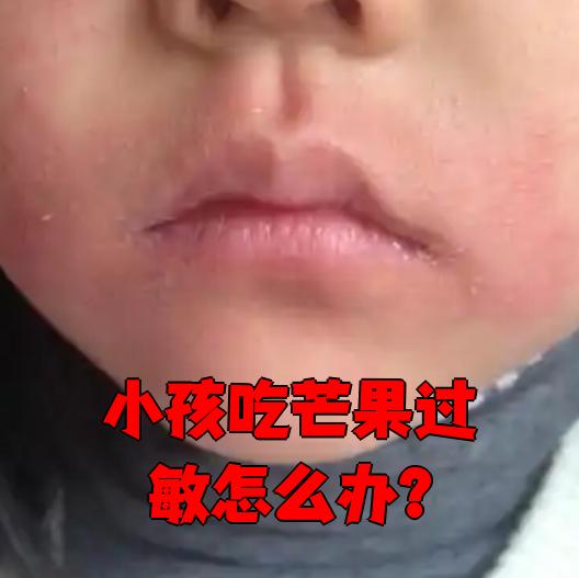 孩子吃芒果过敏时,家长要马上做这几件事: