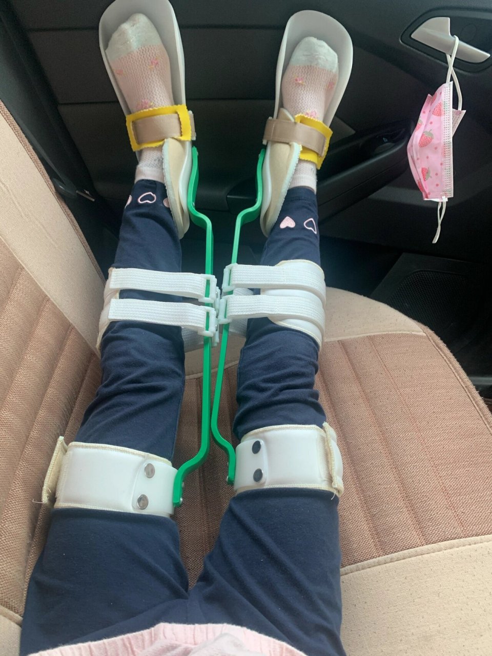 7岁o型腿矫正 宝宝有极轻度的o型腿,医生说没事, 征求了孩子的意见