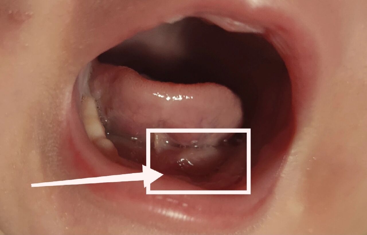 3月宝宝,舌根长疙瘩,会是舌下腺囊肿吗?