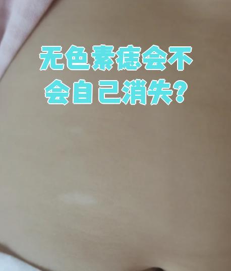 无色素痣不会自己消失
